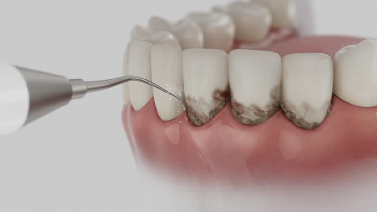 Trusted Wisdom Tooth Removal service in South Holland, IL - Dentist Open Now
